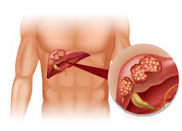 Ways Alcohol Can Damage Your Liver download 34 - Ways Alcohol Can Damage Your Liver